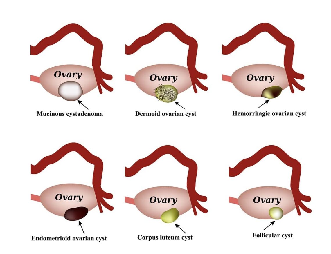 types of ovarian cysts Archives | Best Uro-Gynecologist Los Angeles, OB