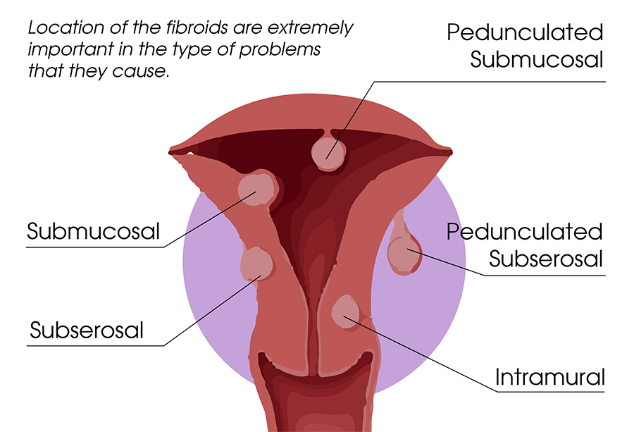 types of fibroids