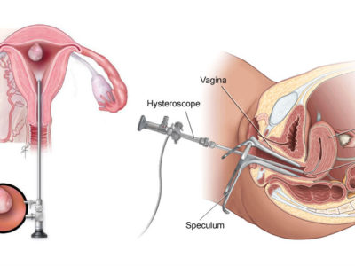 hysteroscopic resection in los angeles and glendale