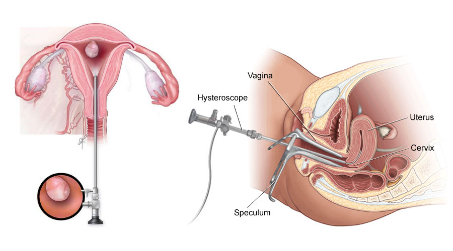 hysteroscopic resection in los angeles and glendale