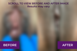 Labiaplasty before and after in Los Angeles, Glendale | Dr. Michael Tahery