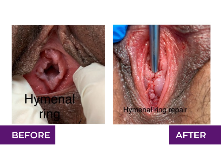 hymenoplasty, hymenal ring repair