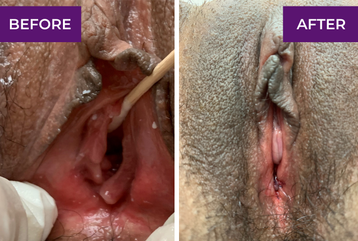 hymenoplasty before and after