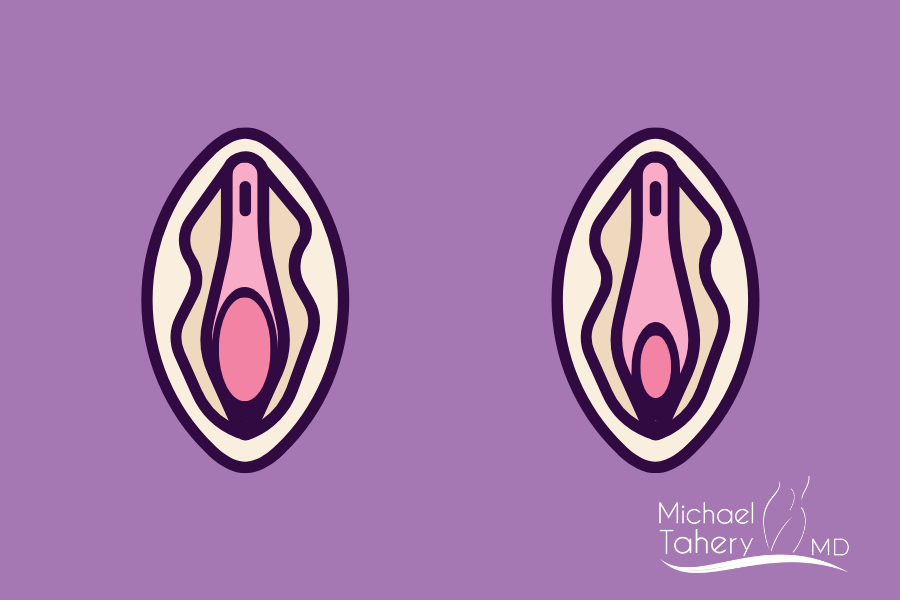 Facts And Myths About A Loose Vagina | Dr. Tahery
