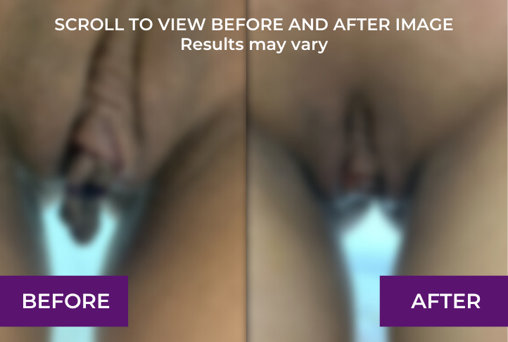 before and after labiaplasty in los angeles