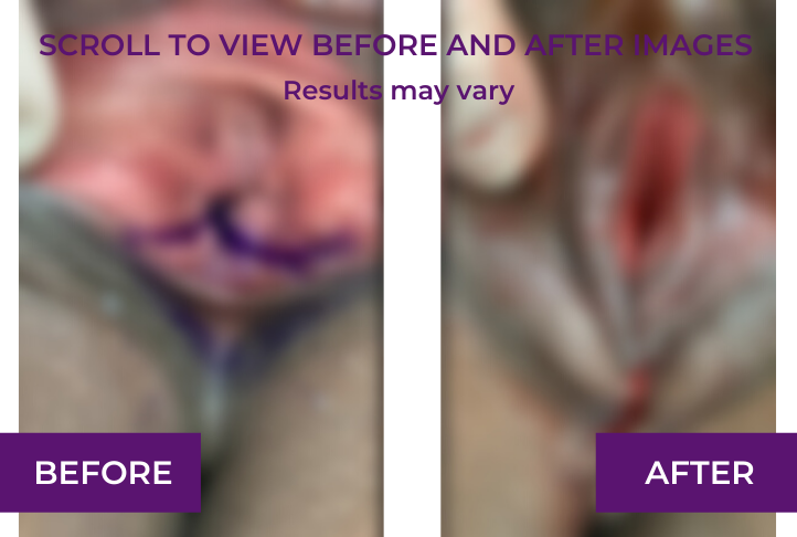Perineoplasty, immediately after repair blur