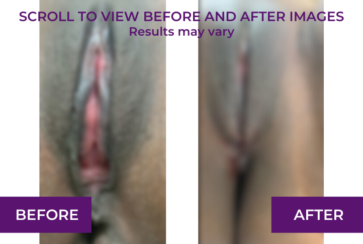 perineoplasty before and after immediately blur