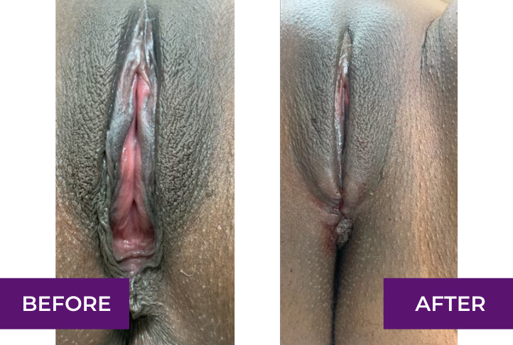 perineoplasty before and after immediately