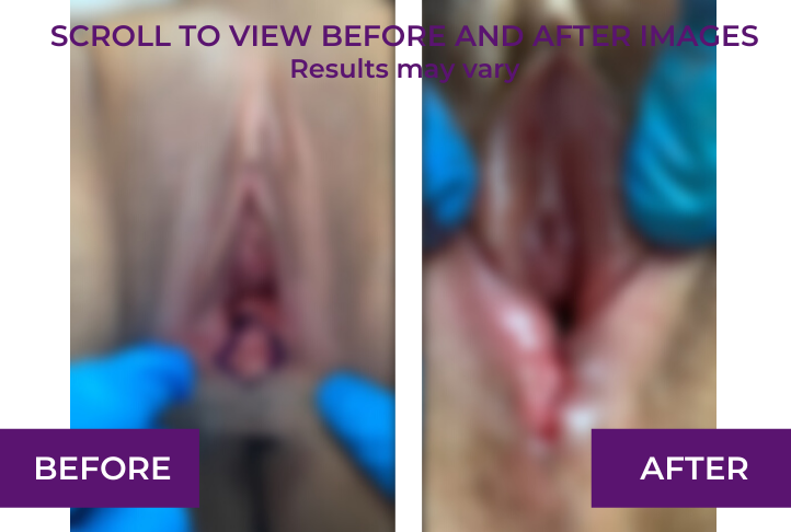 perineoplasty before and after los angeles blur