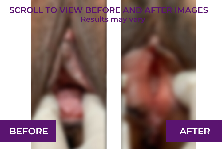 perineoplasty dr tahery before and after blur