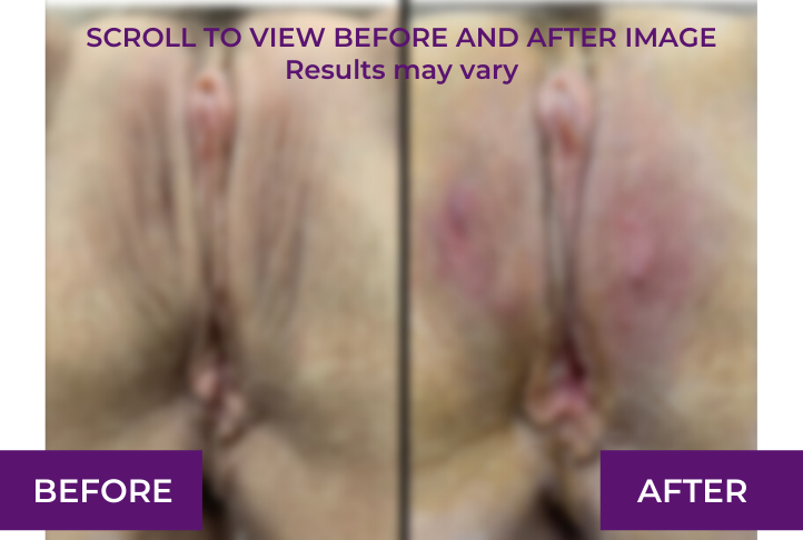 labia puffing before and after in Los Angeles