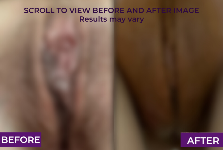 before and after labia puff in Los Angeles
