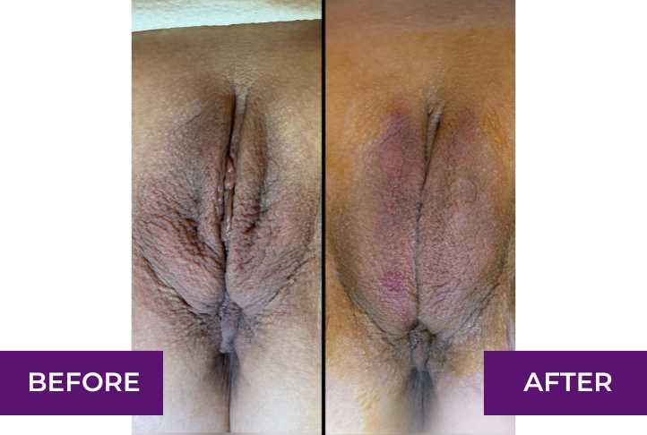 Labia Puffing Before and After in Los Angeles CA
