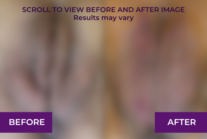 Labia Puffing before and after in Los Angeles