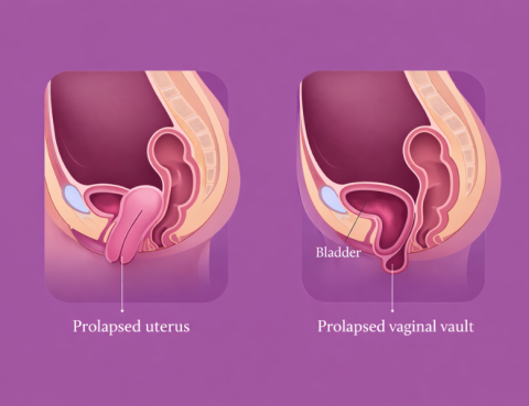 Repairing Severe Vaginal and Uterine Prolapse Without Hysterectomy A Uterus-Preserving Approach